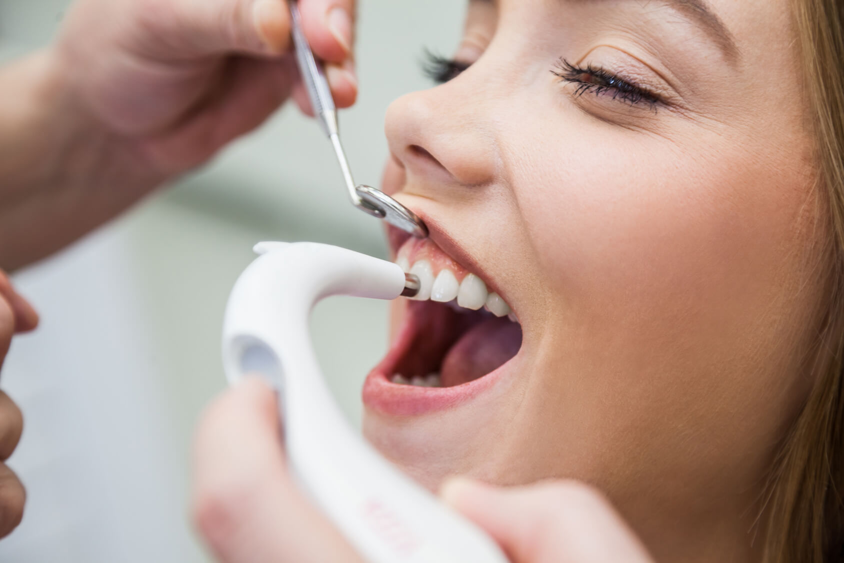Tẩy trắng răng bằng Laser: những vẫn đề cần cân nhắc trước khi thực hiện